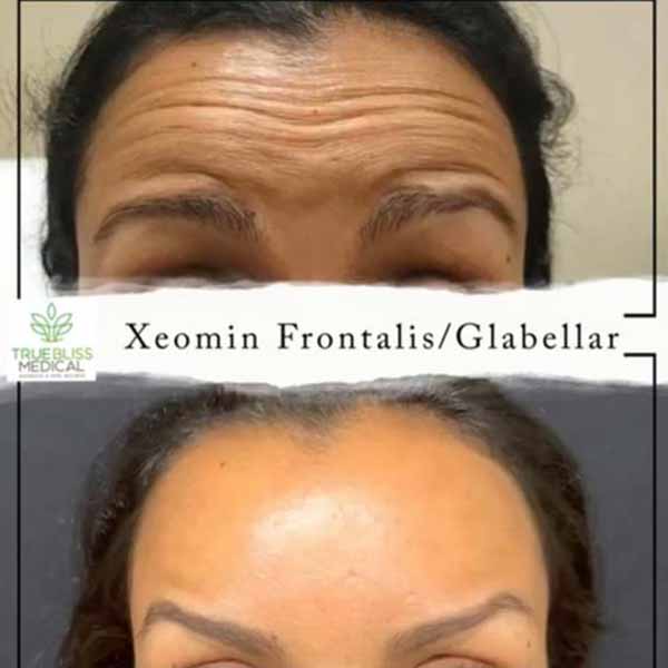 PDO Botox/Neuromodulator Treatment Before & After in Verona, NJ