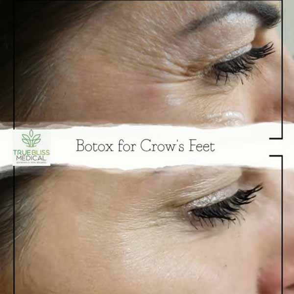 PDO Botox/Neuromodulator Treatment Before & After in Verona, NJ
