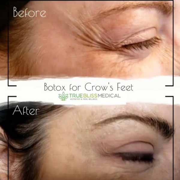 PDO Botox/Neuromodulator Treatment Before & After in Verona, NJ