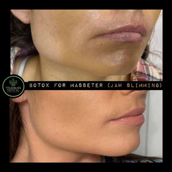 PDO Botox/Neuromodulator Treatment Before & After in Verona, NJ