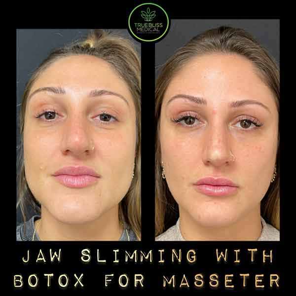 PDO Botox/Neuromodulator Treatment Before & After in Verona, NJ