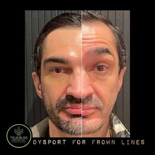 PDO Botox/Neuromodulator Treatment Before & After in Verona, NJ