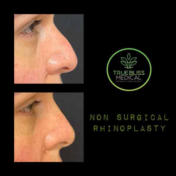 Non-Surgical Rhinoplasty Treatment in Verona, NJ