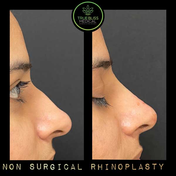 Non-Surgical Rhinoplasty Treatment in Verona, NJ