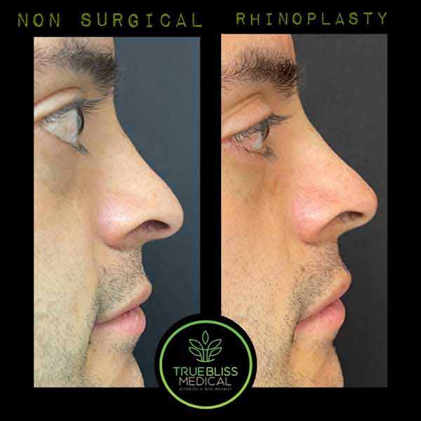 Non-Surgical Rhinoplasty Treatment in Verona, NJ