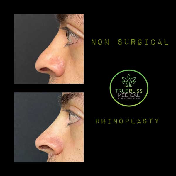 Non-Surgical Rhinoplasty Treatment in Verona, NJ