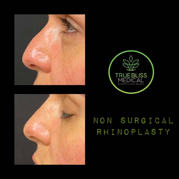 Non-Surgical Rhinoplasty Treatment in Verona, NJ