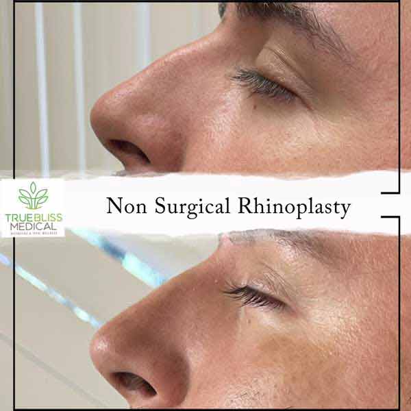 Non-Surgical Rhinoplasty Treatment in Verona, NJ