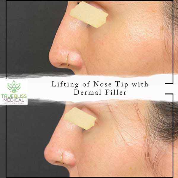 Non-Surgical Rhinoplasty Treatment in Verona, NJ