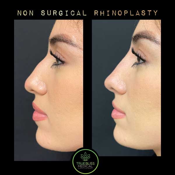 Non-Surgical Rhinoplasty Treatment in Verona, NJ