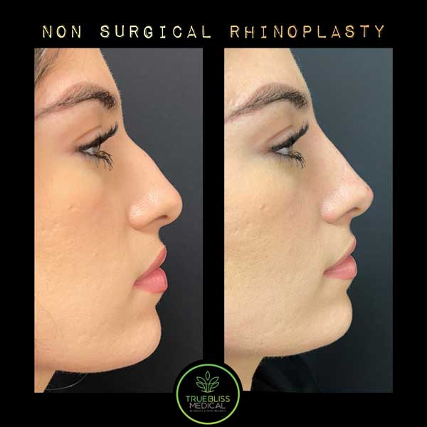 Non-Surgical Rhinoplasty Treatment in Verona, NJ