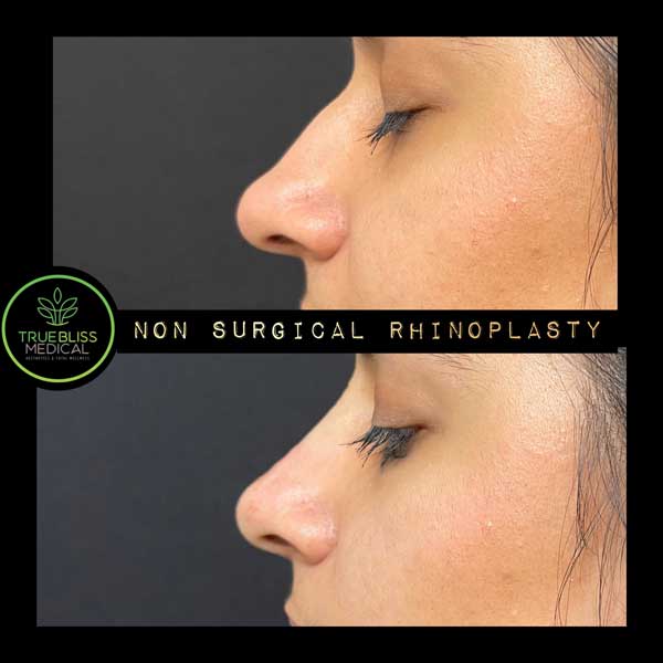 Non-Surgical Rhinoplasty Treatment in Verona, NJ