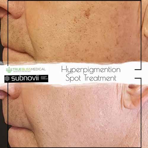 Subnovii Fibroblast Pen Before and After in Verona, NJ