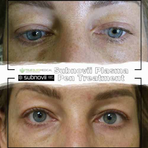Subnovii Fibroblast Pen Before and After in Verona, NJ
