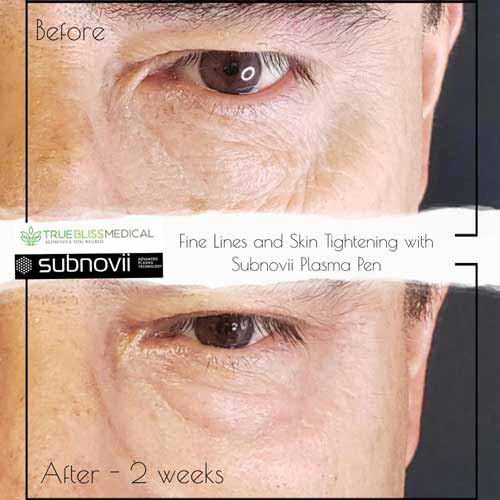 Subnovii Fibroblast Pen Before and After in Verona, NJ