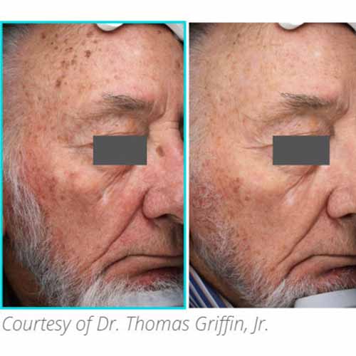 Subnovii Fibroblast Pen Before and After in Verona, NJ