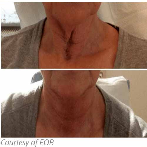 Subnovii Fibroblast Pen Before and After in Verona, NJ