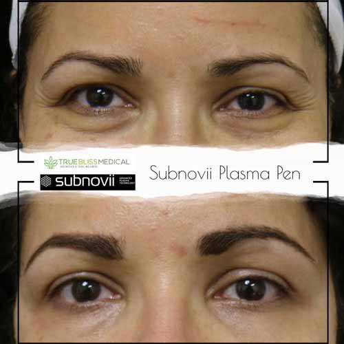 Subnovii Fibroblast Pen Before and After in Verona, NJ