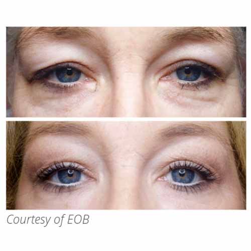 Subnovii Fibroblast Pen Before and After in Verona, NJ