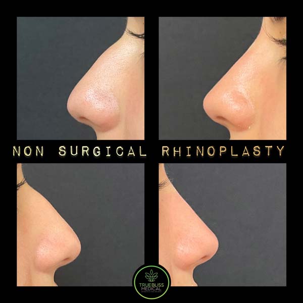 Non-Surgical Rhinoplasty Treatment in Verona, NJ