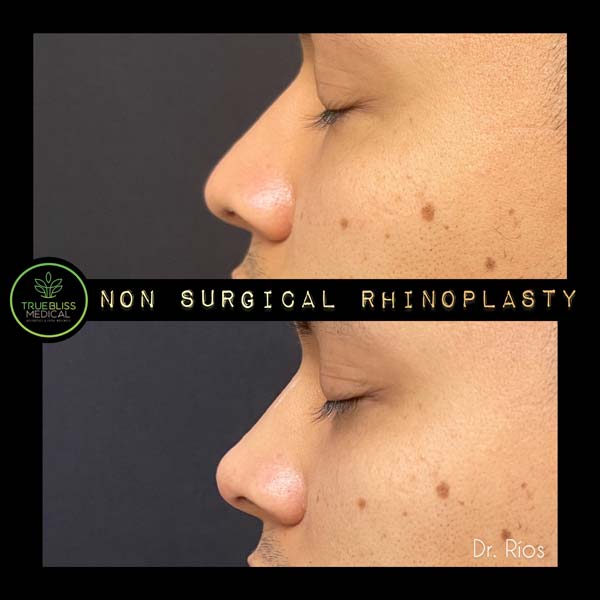 Non-Surgical Rhinoplasty Treatment in Verona, NJ