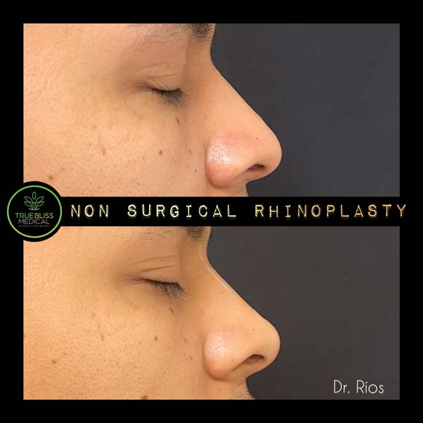 Non-Surgical Rhinoplasty Treatment in Verona, NJ