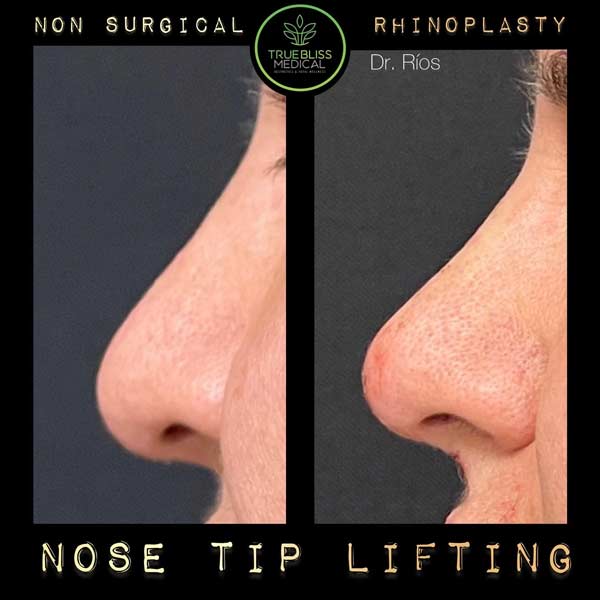 Non-Surgical Rhinoplasty Treatment in Verona, NJ