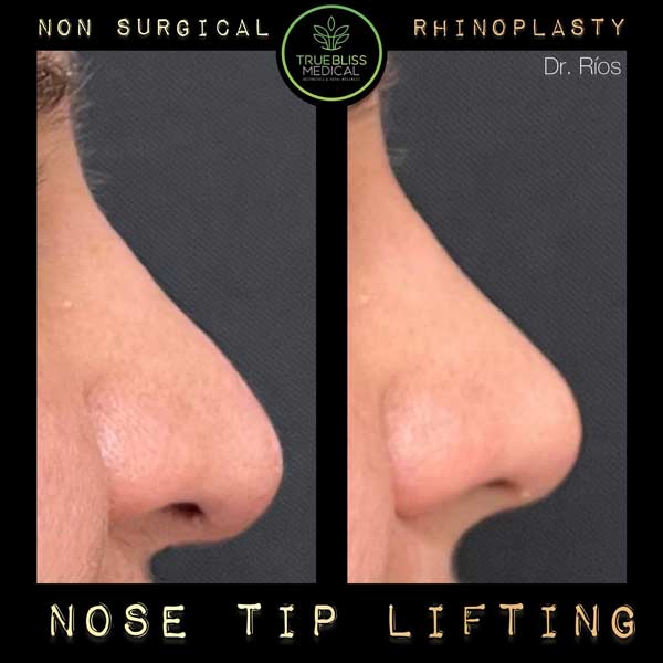 Non-Surgical Rhinoplasty Treatment in Verona, NJ