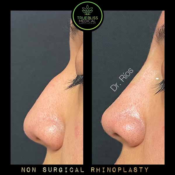 Non-Surgical Rhinoplasty Treatment in Verona, NJ