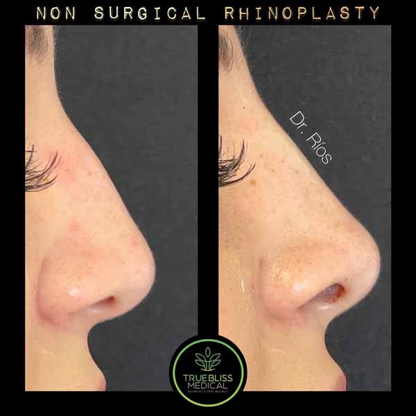 Non-Surgical Rhinoplasty Treatment in Verona, NJ