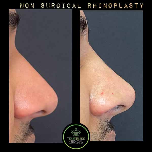 Non-Surgical Rhinoplasty Treatment in Verona, NJ