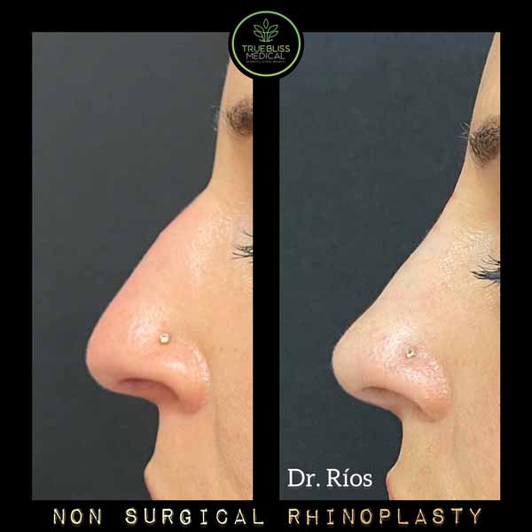 Non-Surgical Rhinoplasty Treatment in Verona, NJ