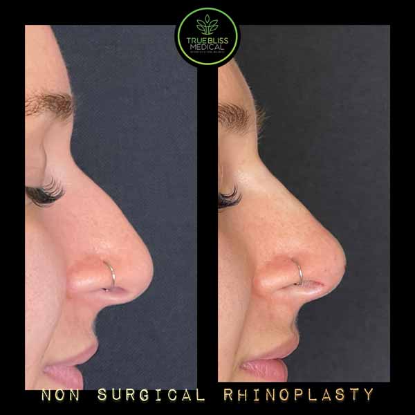 Non-Surgical Rhinoplasty Treatment in Verona, NJ