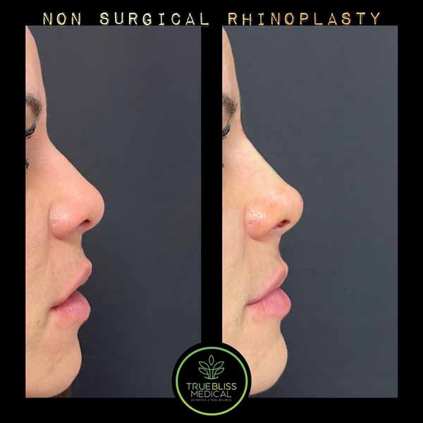 Non-Surgical Rhinoplasty Treatment in Verona, NJ
