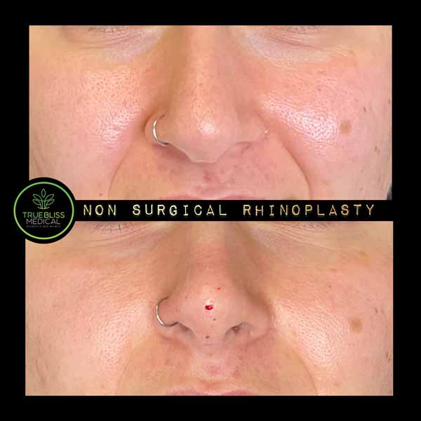 Non-Surgical Rhinoplasty Treatment in Verona, NJ