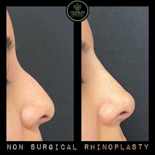 Non-Surgical Rhinoplasty Treatment in Verona, NJ