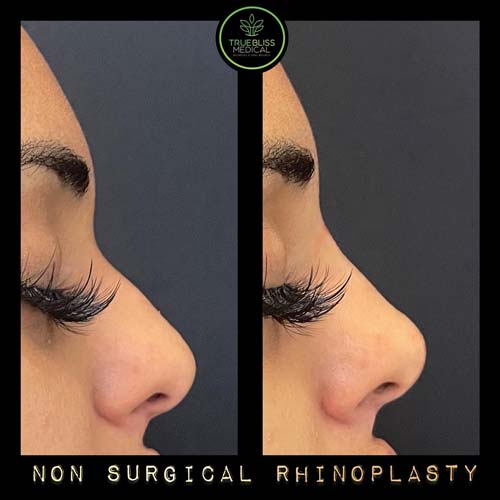Non-Surgical Rhinoplasty Treatment in Verona, NJ