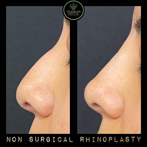 Non-Surgical Rhinoplasty Treatment in Verona, NJ