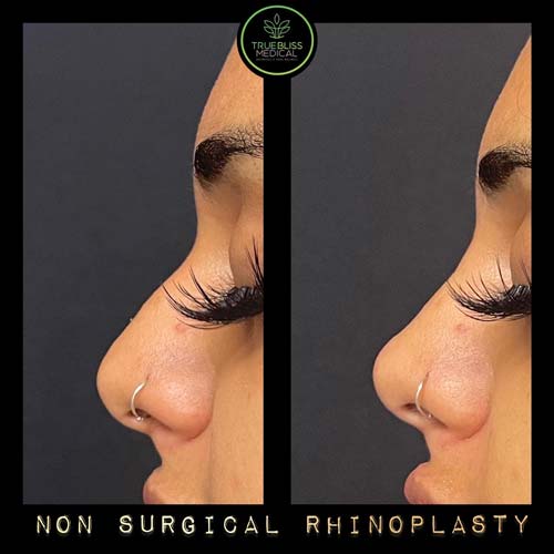 Non-Surgical Rhinoplasty Treatment in Verona, NJ