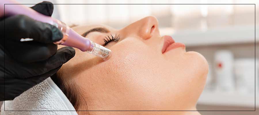 Benefits of Microneedling Treatment Near Me in Verona, NJ