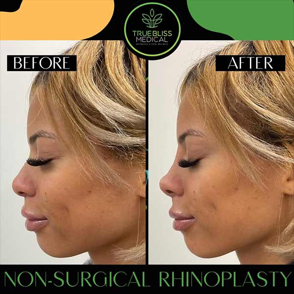 Non-Surgical Rhinoplasty Treatment in Verona, NJ