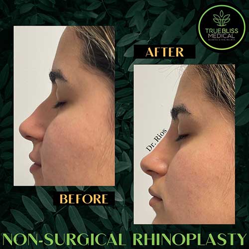 Non-Surgical Rhinoplasty Treatment in Verona, NJ