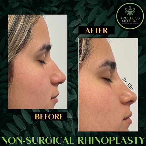 Non-Surgical Rhinoplasty Treatment in Verona, NJ
