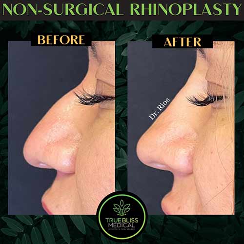 Non-Surgical Rhinoplasty Treatment in Verona, NJ