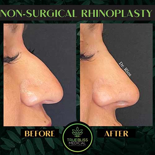 Non-Surgical Rhinoplasty Treatment in Verona, NJ