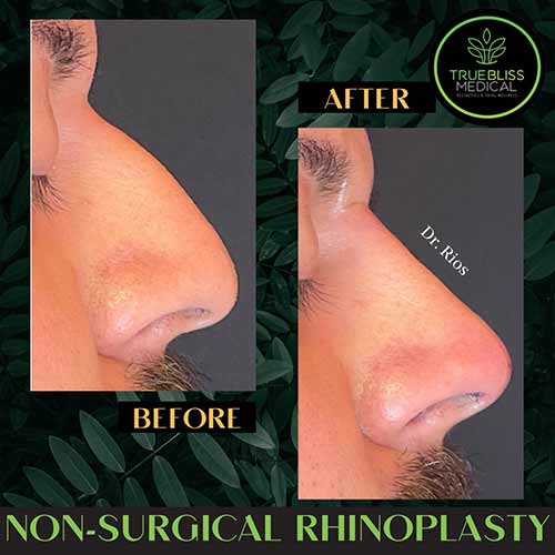 Non-Surgical Rhinoplasty Treatment in Verona, NJ