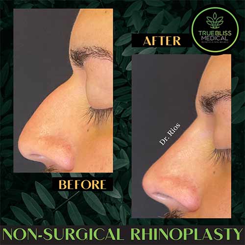 Non-Surgical Rhinoplasty Treatment in Verona, NJ