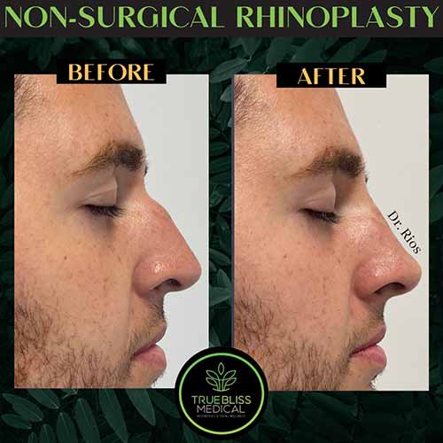 Non-Surgical Rhinoplasty Treatment in Verona, NJ