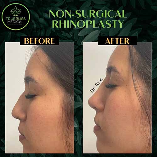 Non-Surgical Rhinoplasty Treatment in Verona, NJ