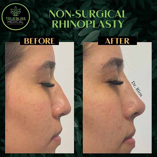 Non-Surgical Rhinoplasty Treatment in Verona, NJ